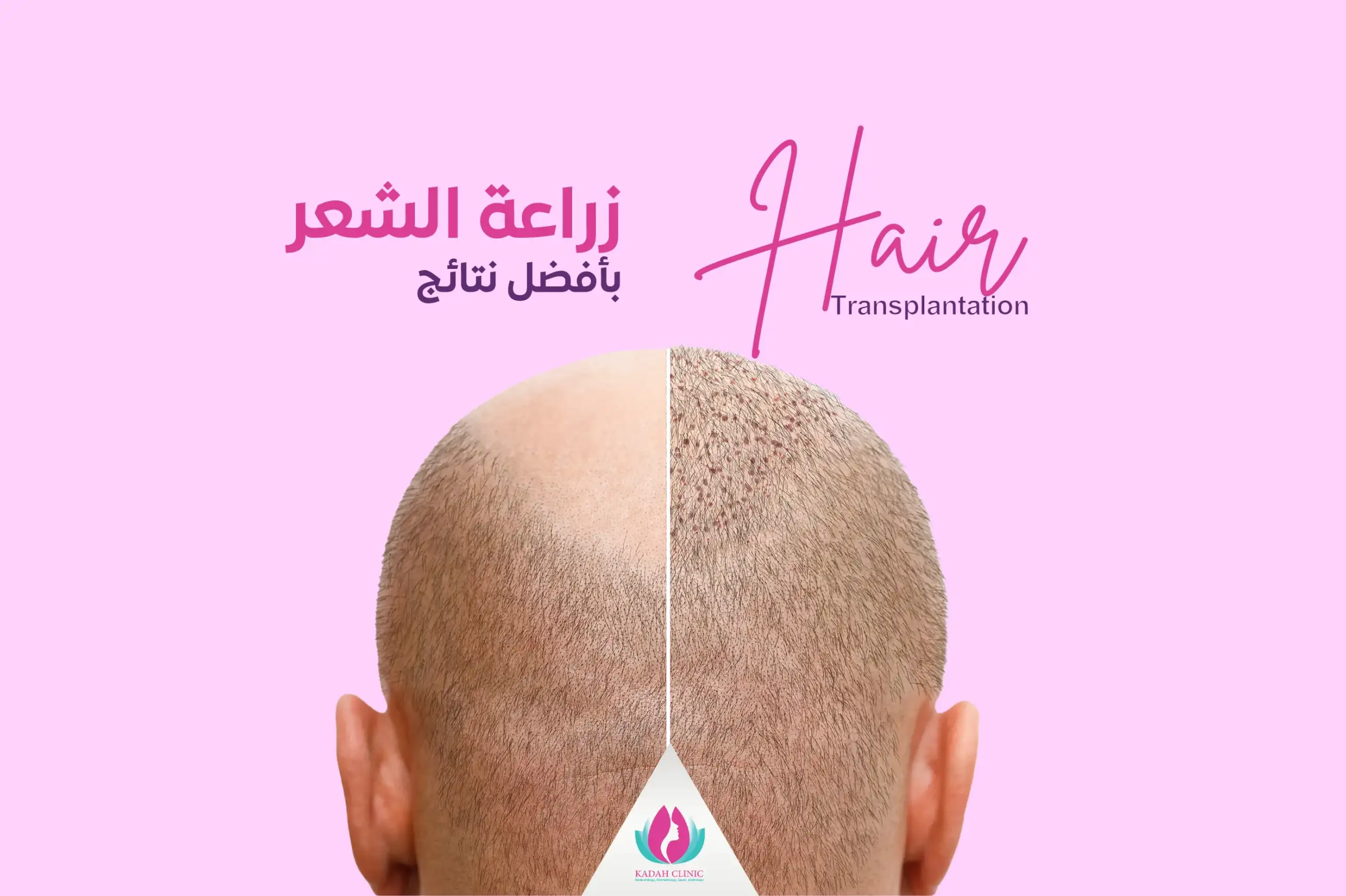 Hair Transplantation 1 hair-transplant