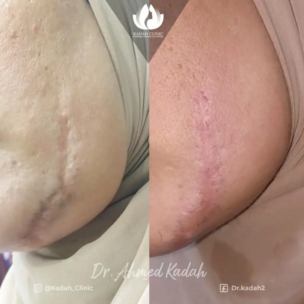 ازالة اثار الجروح من الوجه