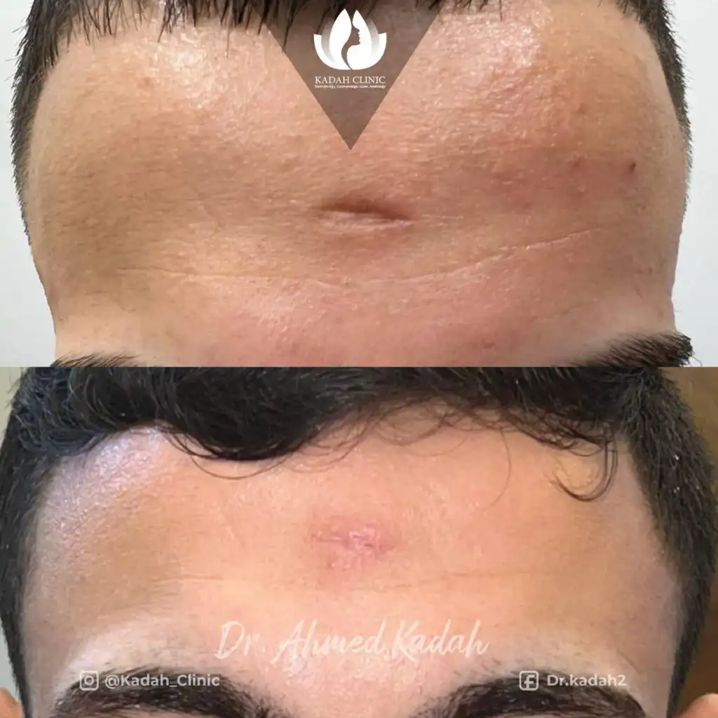 ازالة ندبة بالجبه
