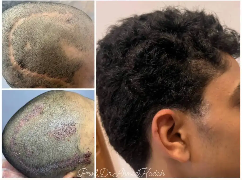 افضل مركز في مصر لزراعة الشعر للرجال