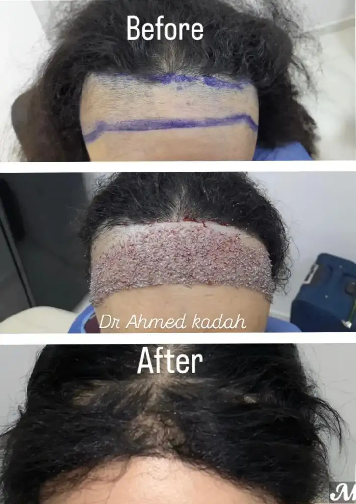 أفضل مركز طبي في بنها لزراعة الشعر للنساء