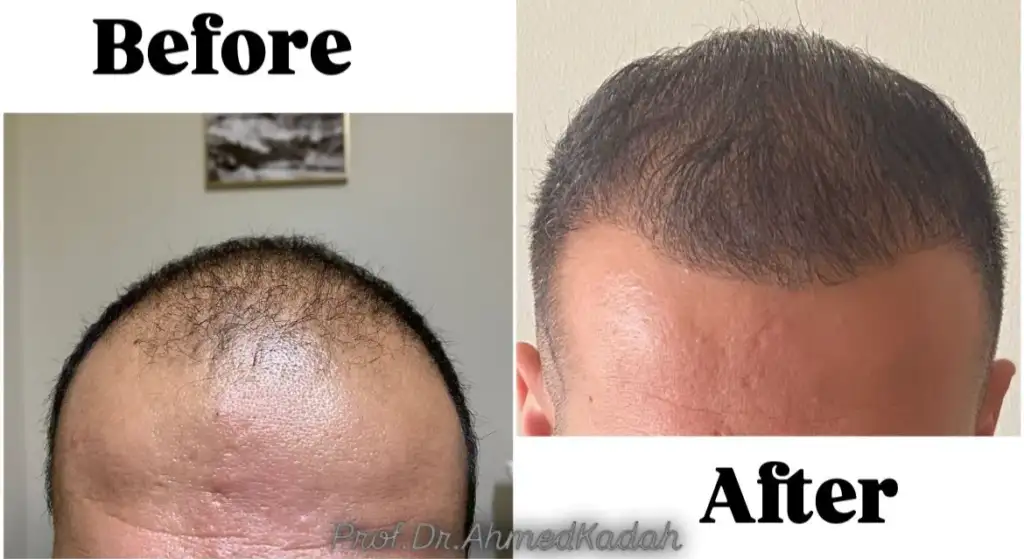 زراعة الشعر - مركز قدح كلينك بنها