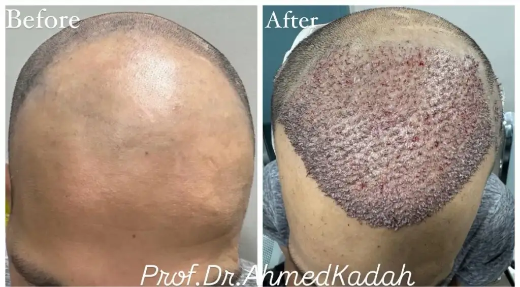 شروط زراعة الشعر للرجال