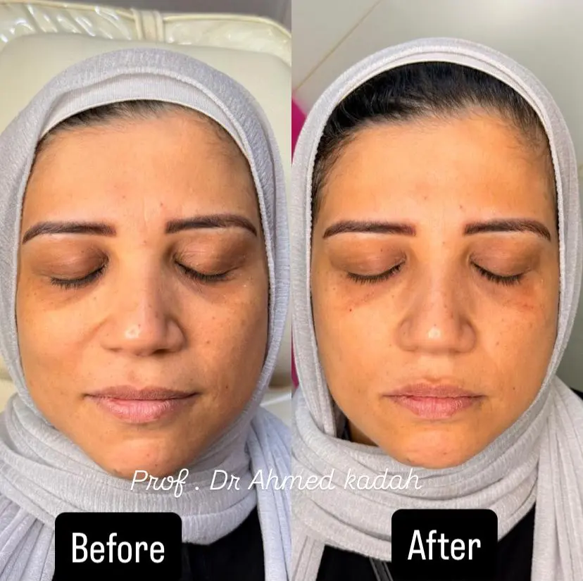 علاج تجويف العين قبل وبعد
