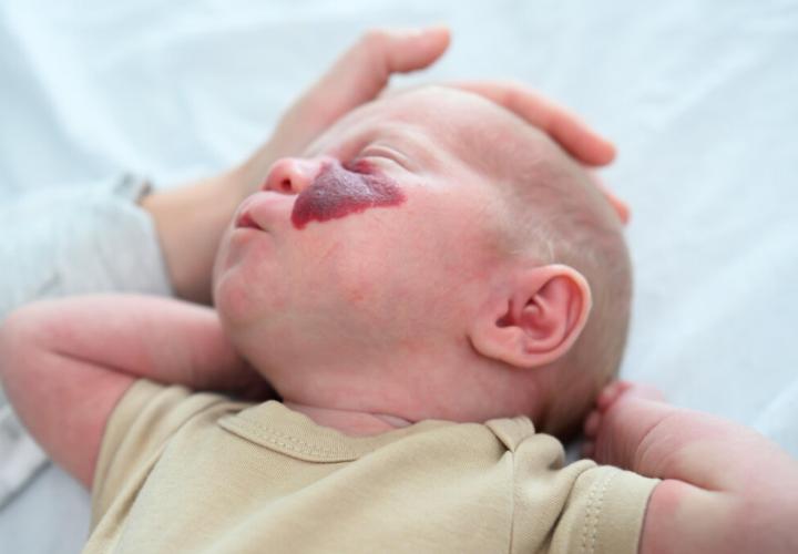 FY23-HemOnc-Hemangioma-6807
