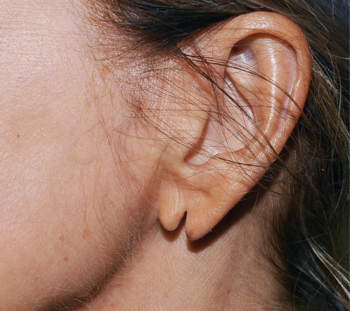 split-earlobe-repair-edinburgh